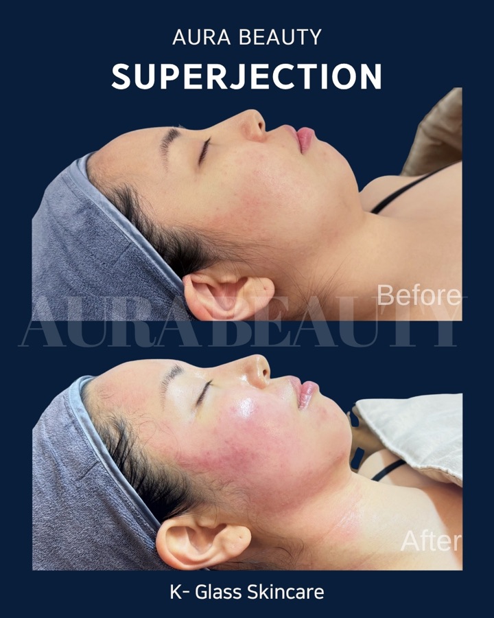 Aura Beauty Superjection K-Glass Skincare side-profile before and after.