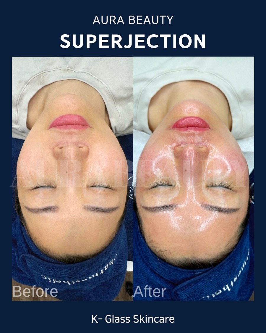 Superjection full-face hydration result: plumper, dewier finish.