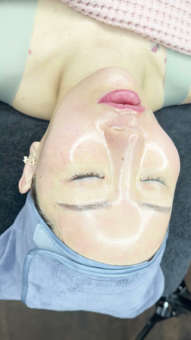 Glass-skin result after a Superjection treatment, product still glossy on the face