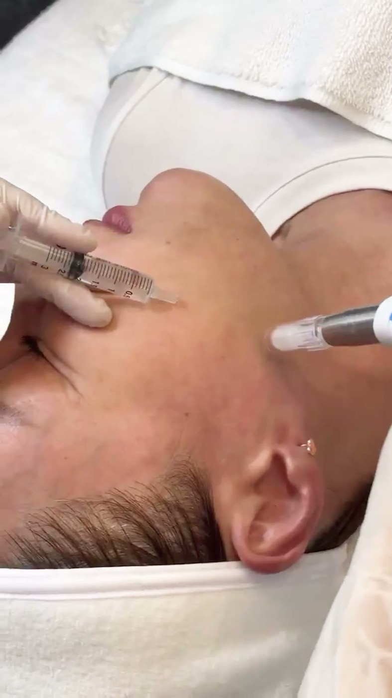 Close-up of the Superjection applicator being worked across a client's cheek